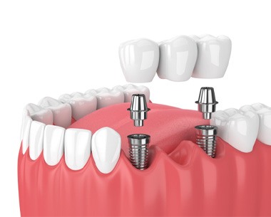 Illustration showing dental implant bridge