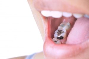 closeup of amalgam fillings that could expand and damage the tooth