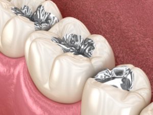 diagram of amalgam fillings that required removing tooth enamel