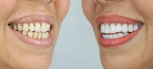 Close-up of person’s smile before and after cosmetic dental treatments