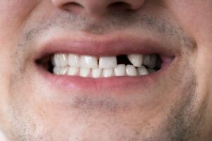Close-up photo of man’s smile with missing front tooth