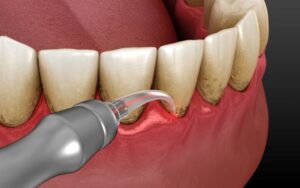 Illustration of laser being used to treat gum disease