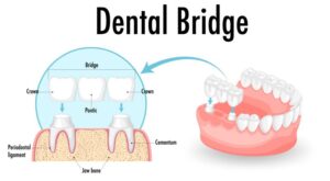 Infographic showing how a dental bridge works 