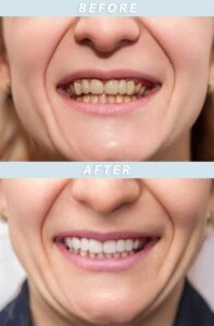 Before and after image of patient’s teeth with dental crowns