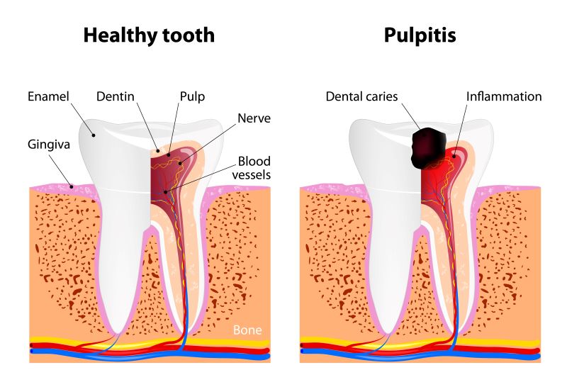 healthy tooth vs tooth with pulpitis