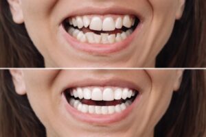 Before and after image of Invisalign treatment