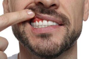 Man lifting his lip to show his gums